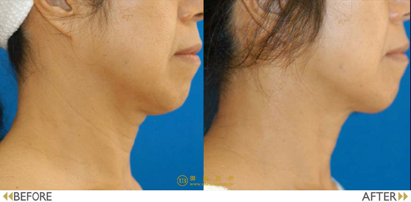 女王電波除了臉部療程外，也能同時改善女性在意的脖子紋路